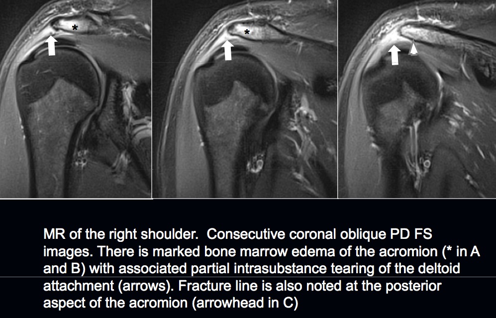 Figure 2 for case Partial deltoid tendon tear